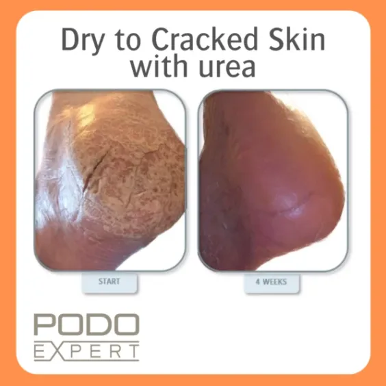 Podoexpert Dry To Cracked Skin Foam